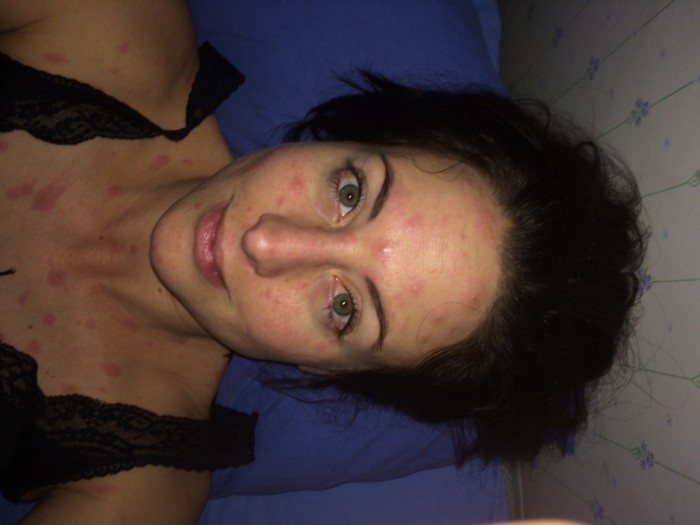 A bout of engagement chicken pox A bout of engagement chicken pox