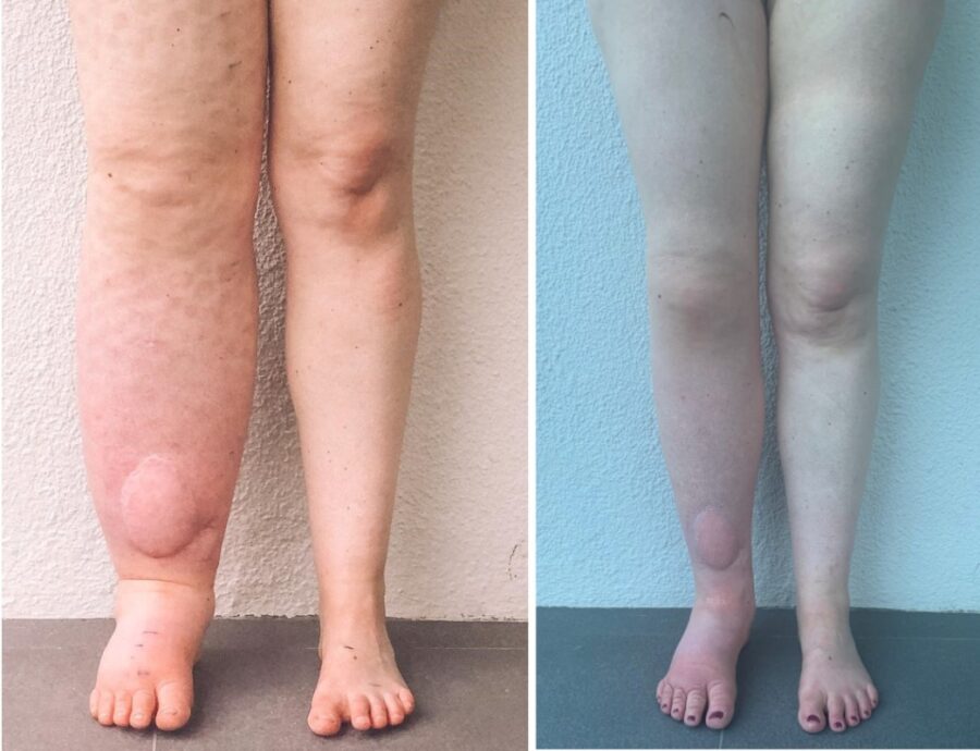 Comparison of leg before and after surgery