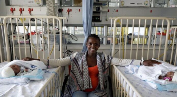 conjoined twins separated Cape Town conjoined twins separated Cape Town South Africa
