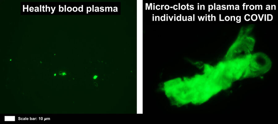 Blood clots Long COVID