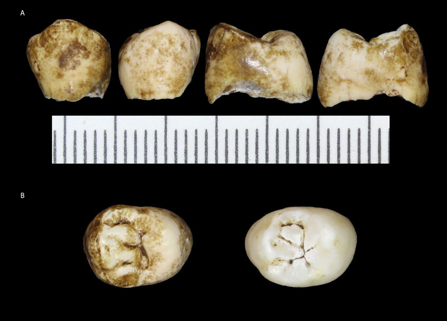 One of Leti’s unemerged permanent premolar teet