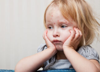 measles outbreak in SA
