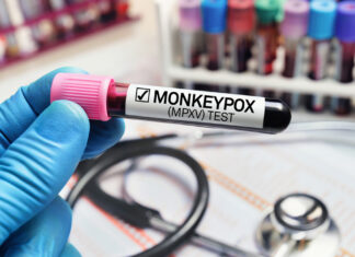 Monkeypox South Africa