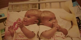 The Separation of Conjoined Twins Gripped SA: Carte Blanche Retraces the Medical Team's Steps