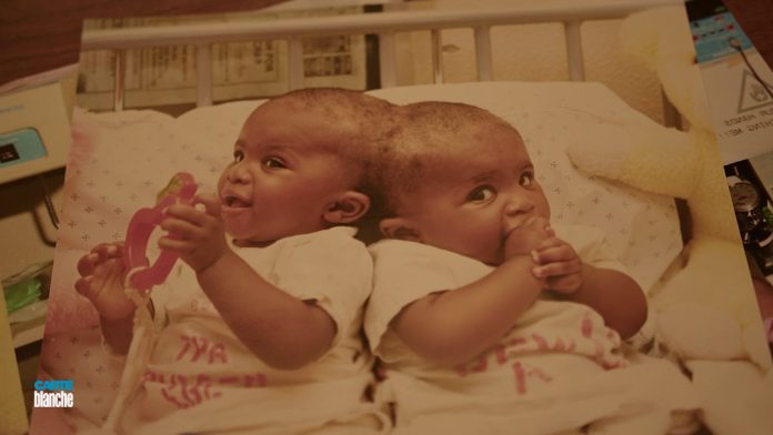 The Separation of Conjoined Twins Gripped SA: Carte Blanche Retraces the Medical Team's Steps