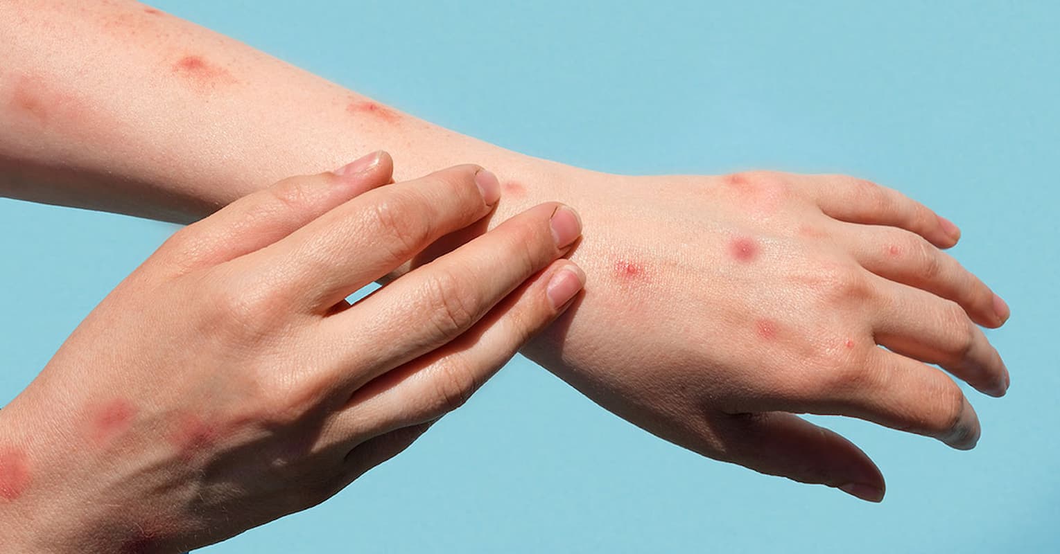 Image of a woman afflicted with mpox. This image accompanies an article titled 'Cape Town mpox cases rise with German and Norwegian infections'